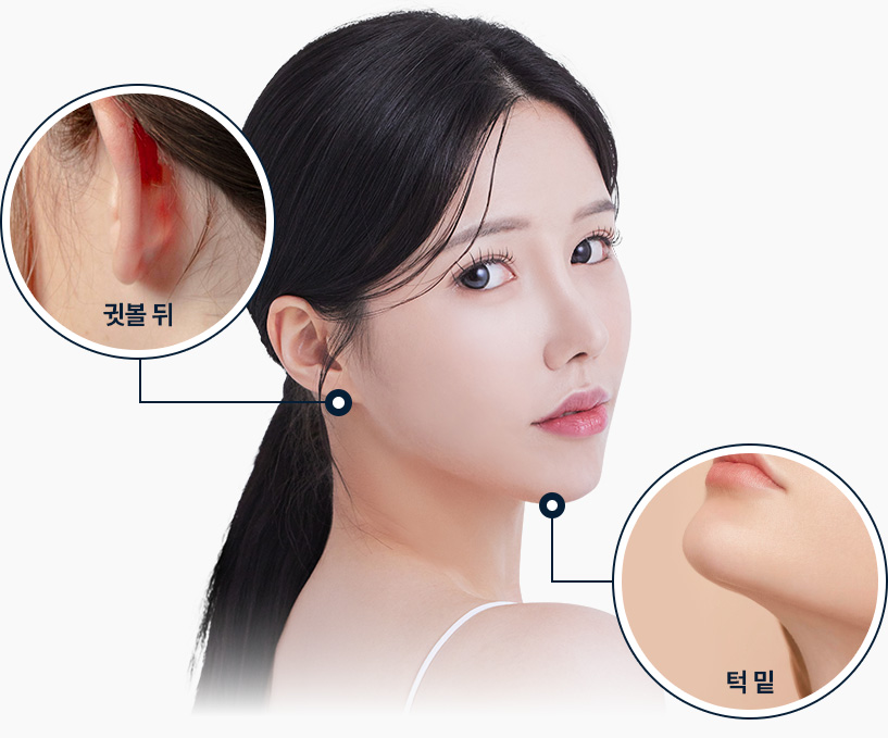 이중턱 지방흡입 절개부위 귓볼뒤 턱밑