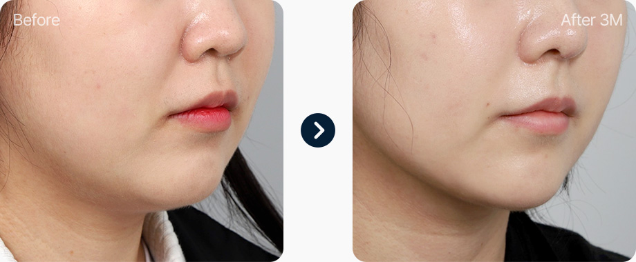 이중턱 지방흡입 전후사진 이중턱지방흡입 후기 3개월후