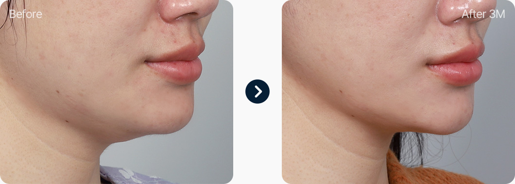 이중턱 지방흡입 전후사진 이중턱지방흡입 후기 3개월후