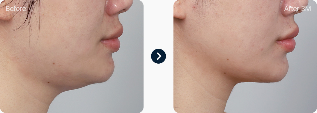 이중턱 지방흡입 전후사진 이중턱지방흡입 후기 3개월후