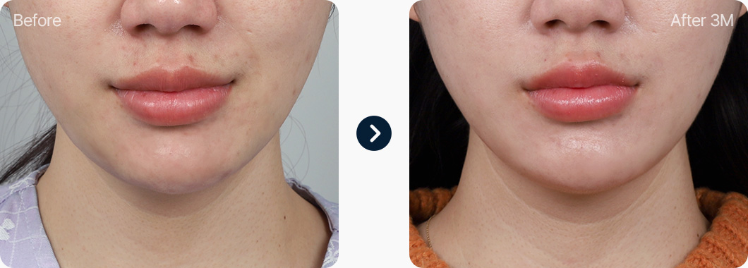 이중턱 지방흡입 전후사진 이중턱지방흡입 후기 3개월후