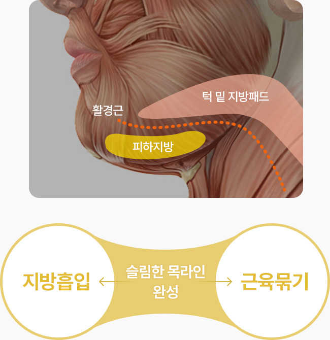 이중턱 근육묶기 턱밑 지방패드 활경근 피하지방 지방흡입과 근육묶기로 슬림한 목라인 완성