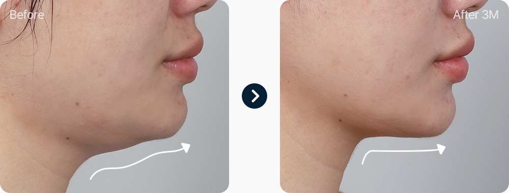 이중턱근육묶기 전후사진 이중턱근육묶기 후기 3개월후