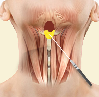 이중턱근육묶기 수술방법 활경근 절개 피하지방 미세 캐뉼라로 흡입