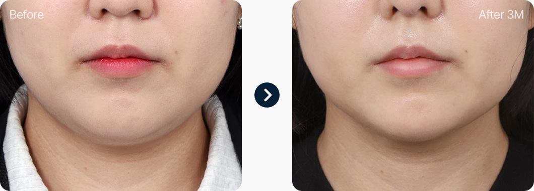 이중턱근육묶기 전후사진 이중턱근육묶기 후기 3개월후