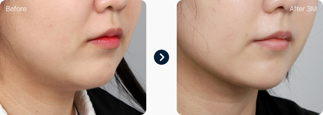 이중턱근육묶기 전후사진 이중턱근육묶기 후기 3개월후