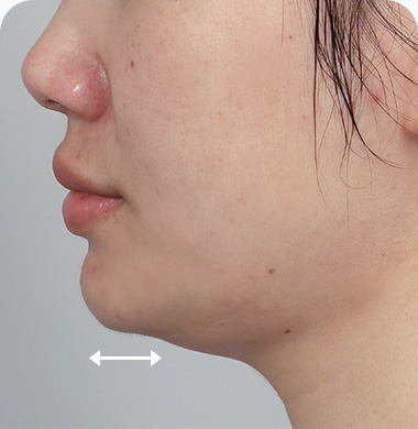 이중턱 근육묶기 추천케이스 1번 짧은 턱길이