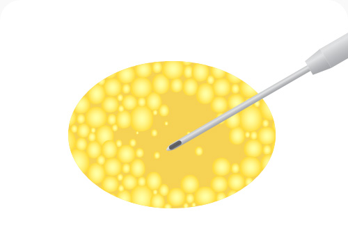 이중턱 지방흡입