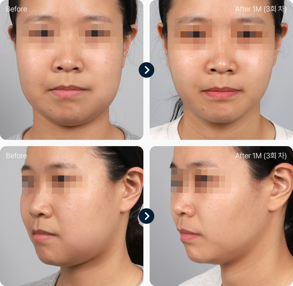 원더핏주사(얼굴) 지방분해주사 전후사진 원더핏주사 후기 1개월후 3회차