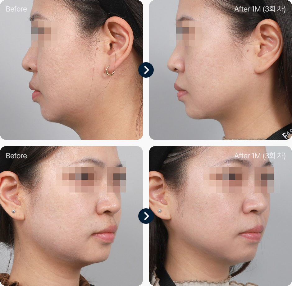원더핏주사(얼굴) 지방분해주사 전후사진 원더핏주사 후기 1개월후 3회차