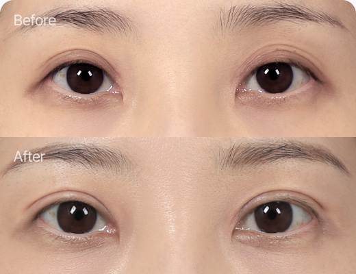 눈위지방이식 전후사진