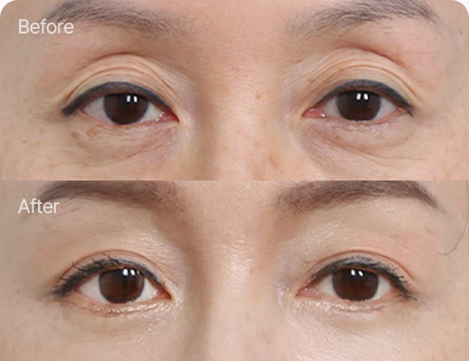 눈위지방이식 전후사진