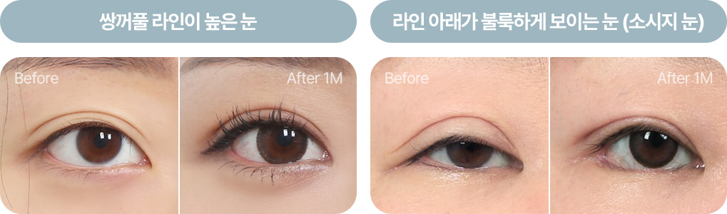 상안검거근 뮬러근