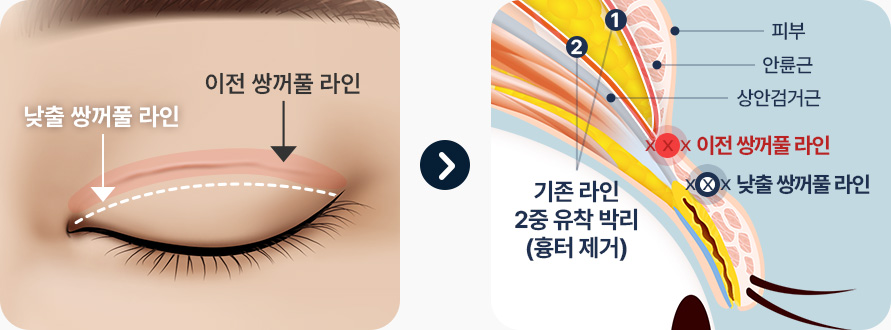 원더풀 라인낮추기 기존 쌍꺼풀 라인 2중 유착 박리 흉터제거