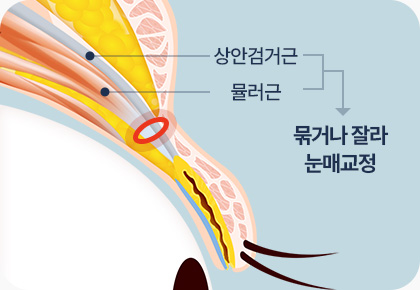 원더풀 라인낮추기 상안검거근 뮬러근 눈매교정