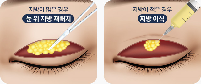눈꺼풀 지방이 적은 경우 눈위지방재배치 지방이 적은 경우 지방이식