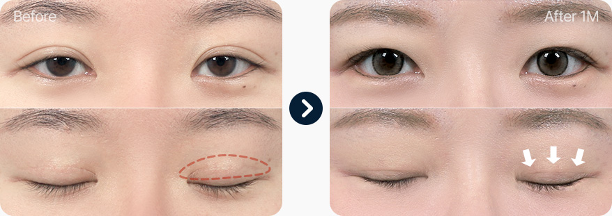 원더풀 라인낮추기 두줄따기 흉터제거 자연스러운 유착