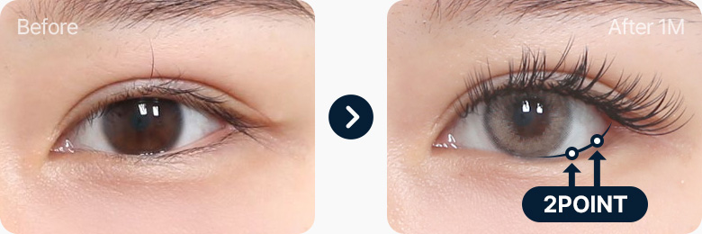 2포인트 고정기법 뒤밑트임 전후사진 