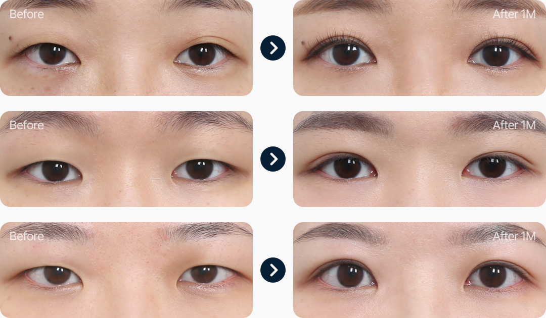 앞트임 윗트임 전후사진