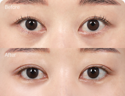 눈밑지방재배치 전후사진