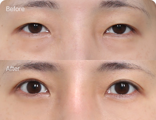 눈밑지방재배치 전후사진