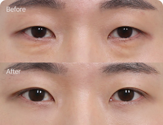 눈밑지방재배치 전후사진