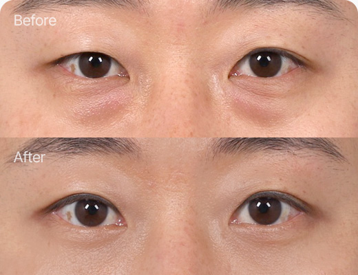 눈밑지방재배치 전후사진