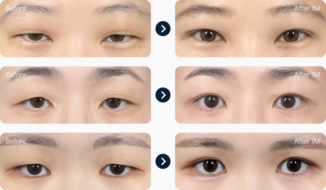 라인낮추기 전후사진