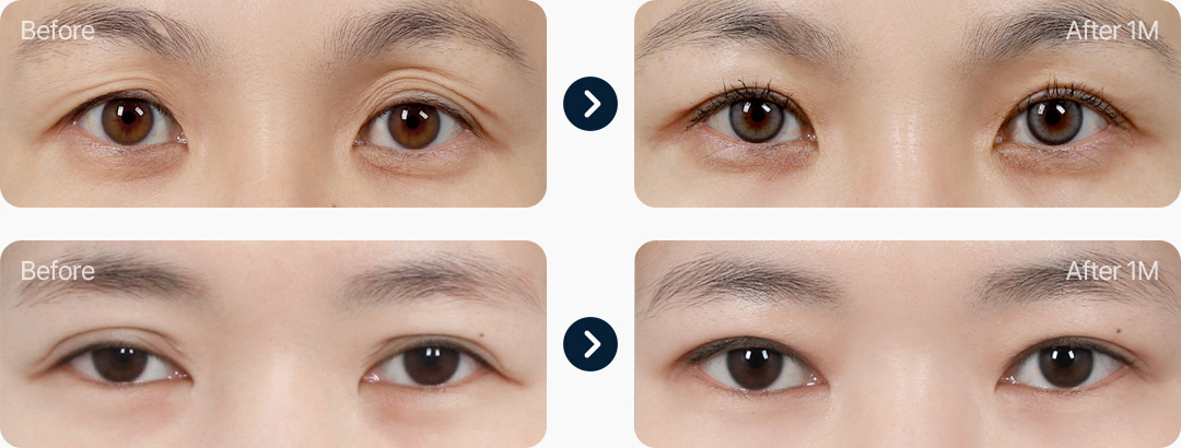 라인낮추기 전후사진