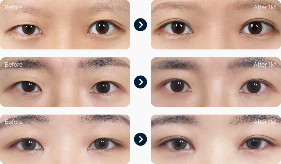 자연유착 전후사진