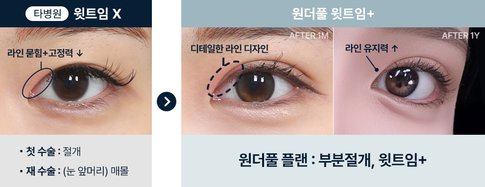 부분절개 