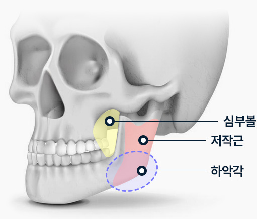 사각턱수술 심부볼 저작근 하악각