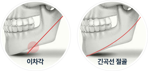 사각턱수술 이차각 예방 긴곡선절골