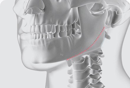사각턱수술 방법 긴곡선 절제술
