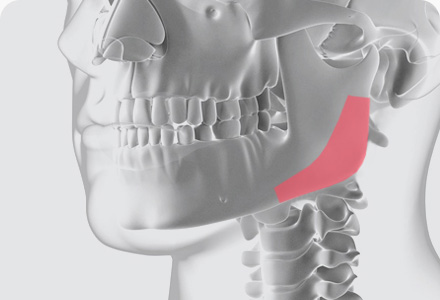 사각턱수술 방법 피질골 절제술