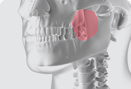 사각턱수술 방법 심부볼 지방제거