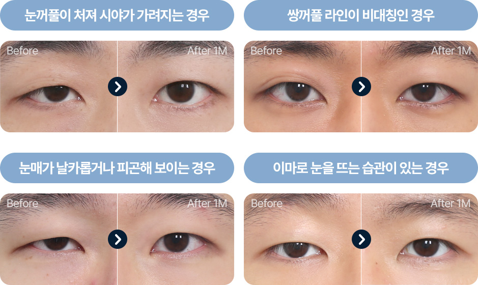 원더풀 부분절개 피부 근육이 두꺼운 경우 피부 처짐 눈위 지방이 많은경우 기존 유착이 심한경우 기존 라인을 낮추는 경우