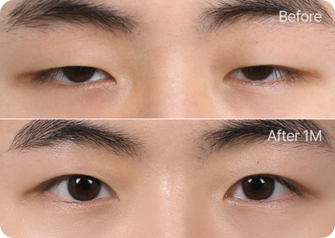 원더풀 무쌍눈매교정 부분절개