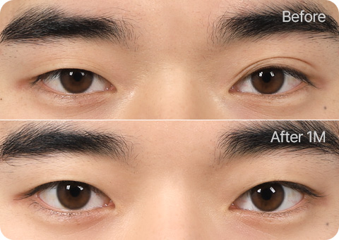 원더풀 무쌍눈매교정 부분절개