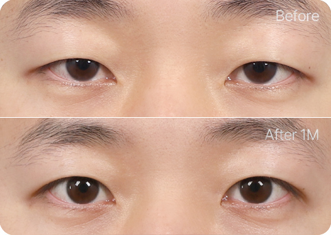 원더풀 무쌍눈매교정 부분절개 눈위지방제거