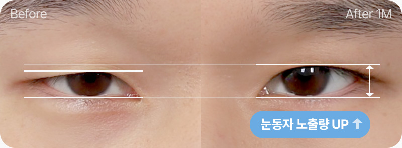 눈동자 노출량 UP 남자무쌍눈매교정 전후사진