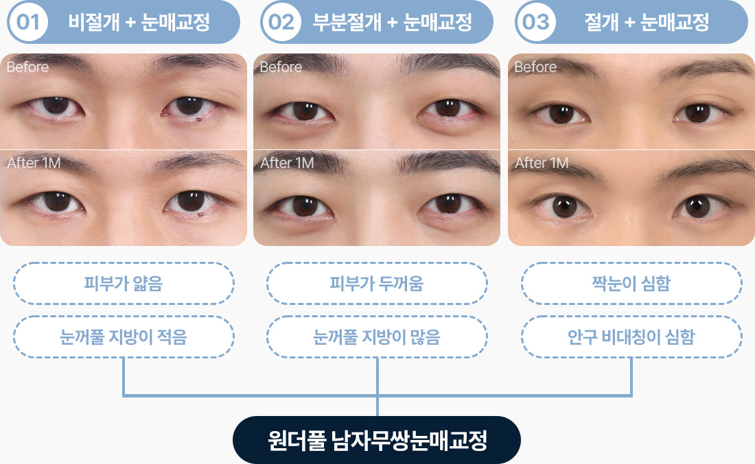 원더풀 남자무쌍눈매교정 얇은 피부 눈꺼풀 지방 적음 비절개+눈매교정 두꺼운 피부 눈꺼풀 지방 많음 부분절개+눈매교정 심한 짝눈 심한 안구비대칭 절개+눈매교정