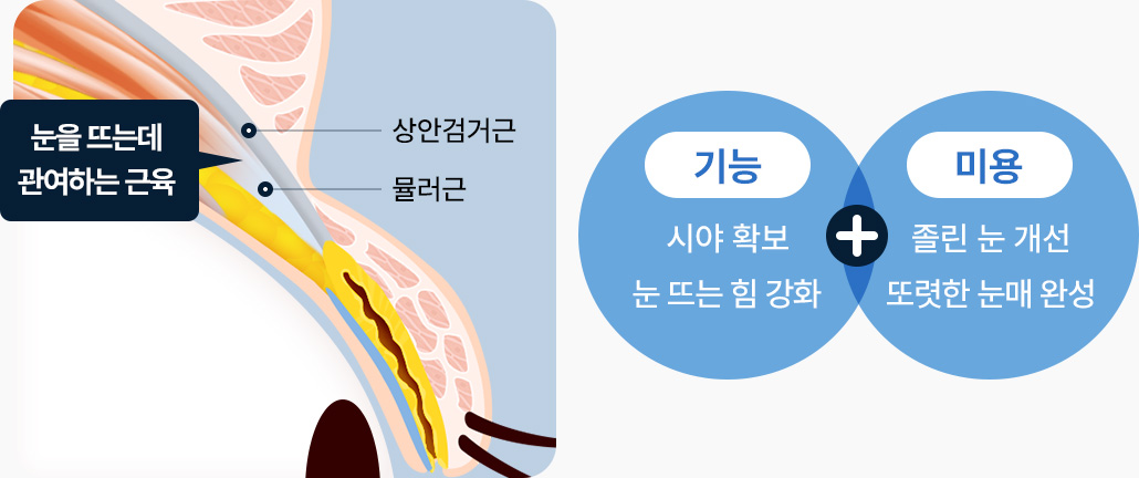 상안검거근 뮬러근 시야 확보 눈뜨는 힘 강화 졸린 눈 개선 또렷한 눈매 완성