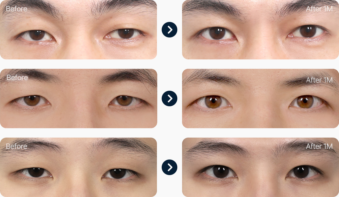 비절개 눈매교정 남자무쌍눈매교정 전후사진