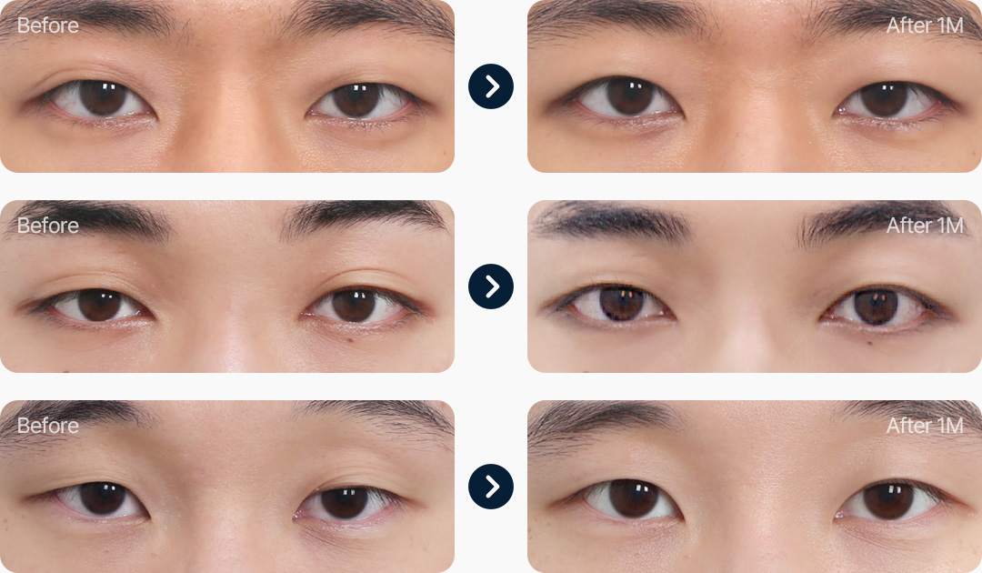 부분절개 눈매교정 남자무쌍눈매교정 전후사진