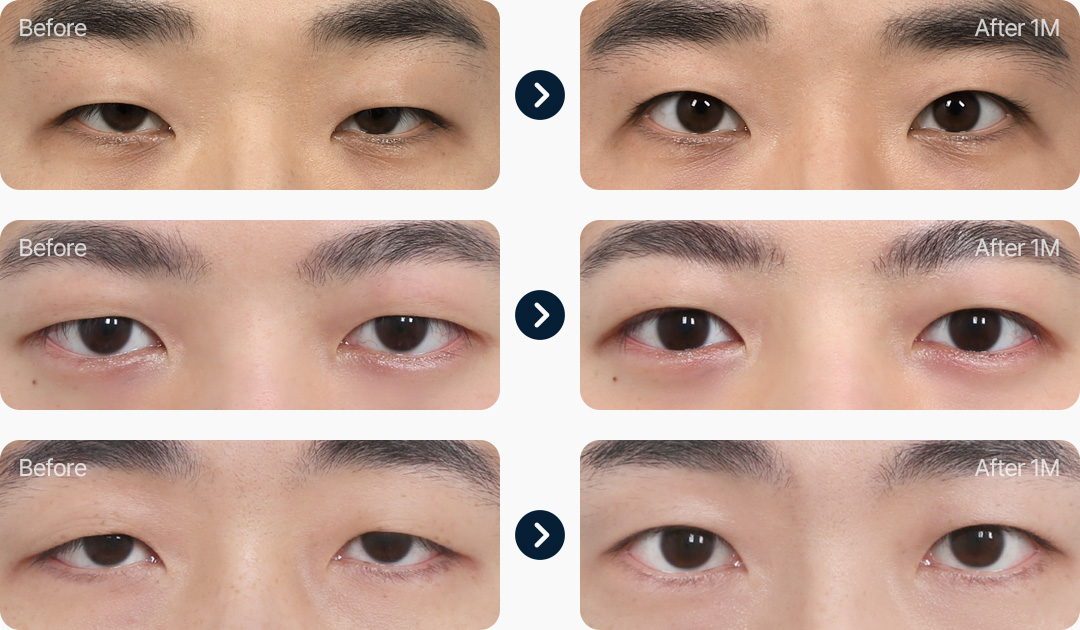 절개 눈매교정 남자무쌍눈매교정 전후사진