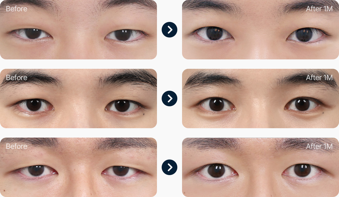 절개 눈매교정 남자무쌍눈매교정 전후사진