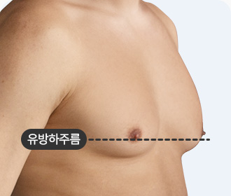 여유증 2-b등급 유방하주름