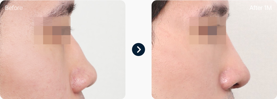 매부리코 성형 전후사진