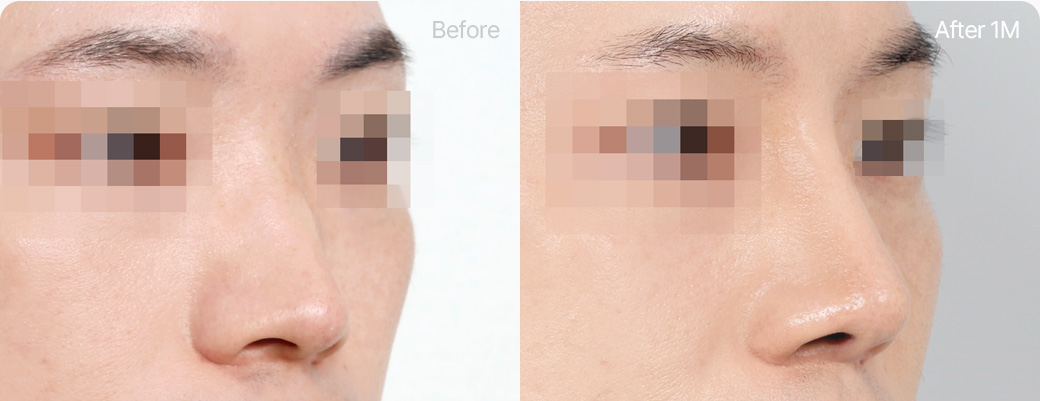 기본코성형 비중격연골 전후사진